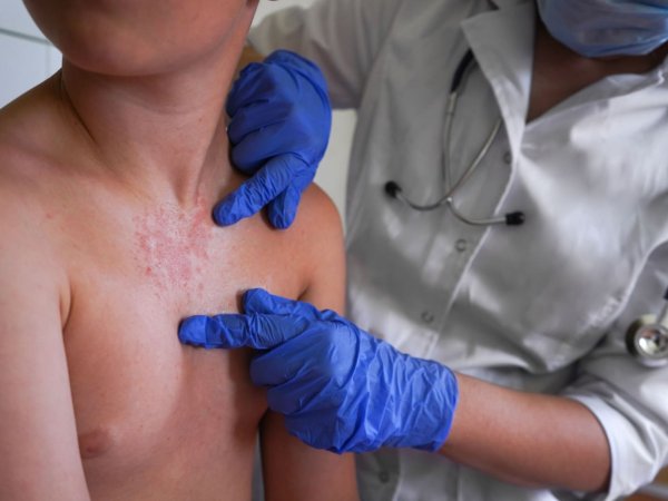 Síntomas y cuidados de la fiebre escarlatina
